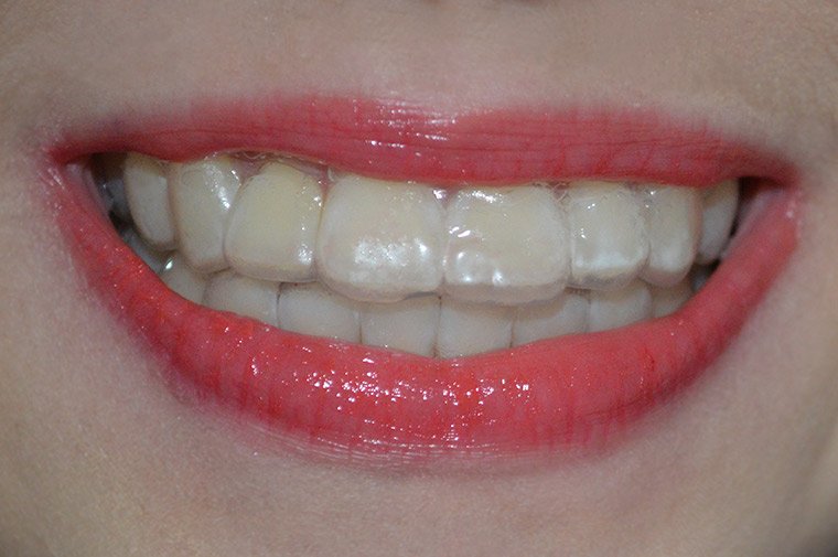 Usando as moldeiras de clareamento dental caseiro
