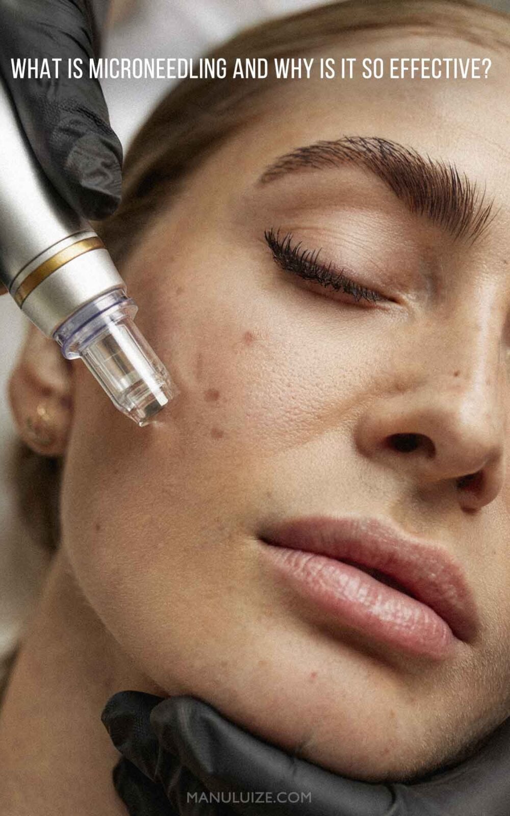 What Is Microneedling and Why Is It So Effective? What Is Microneedling and Why Is It So Effective?